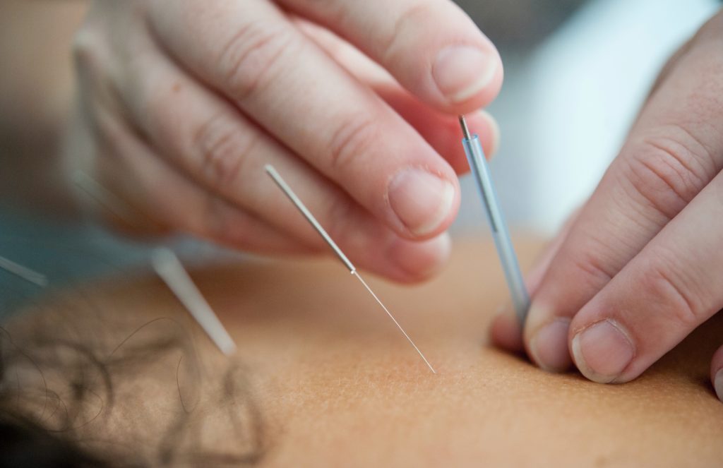 https://nkychiropractor.com/wp-content/uploads/2018/11/dry-needling-1024x663.jpg